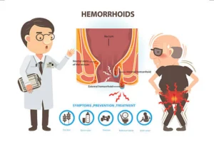 What Most People Get Wrong About Hemorrhoid Stages and Why It Keeps Them in Pain Longer