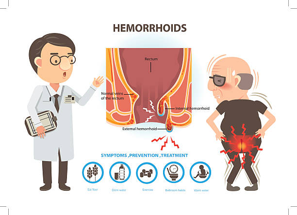 What Most People Get Wrong About Hemorrhoid Stages and Why It Keeps Them in Pain Longer